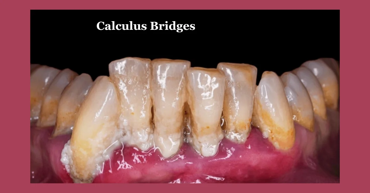 Calculus Bridges: The Hidden Threat to Your Oral Health