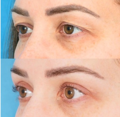 The Ultimate Guide to Laser Blepharoplasty: Everything You Need to Know